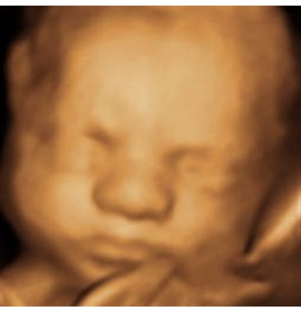 ultrasound image of baby